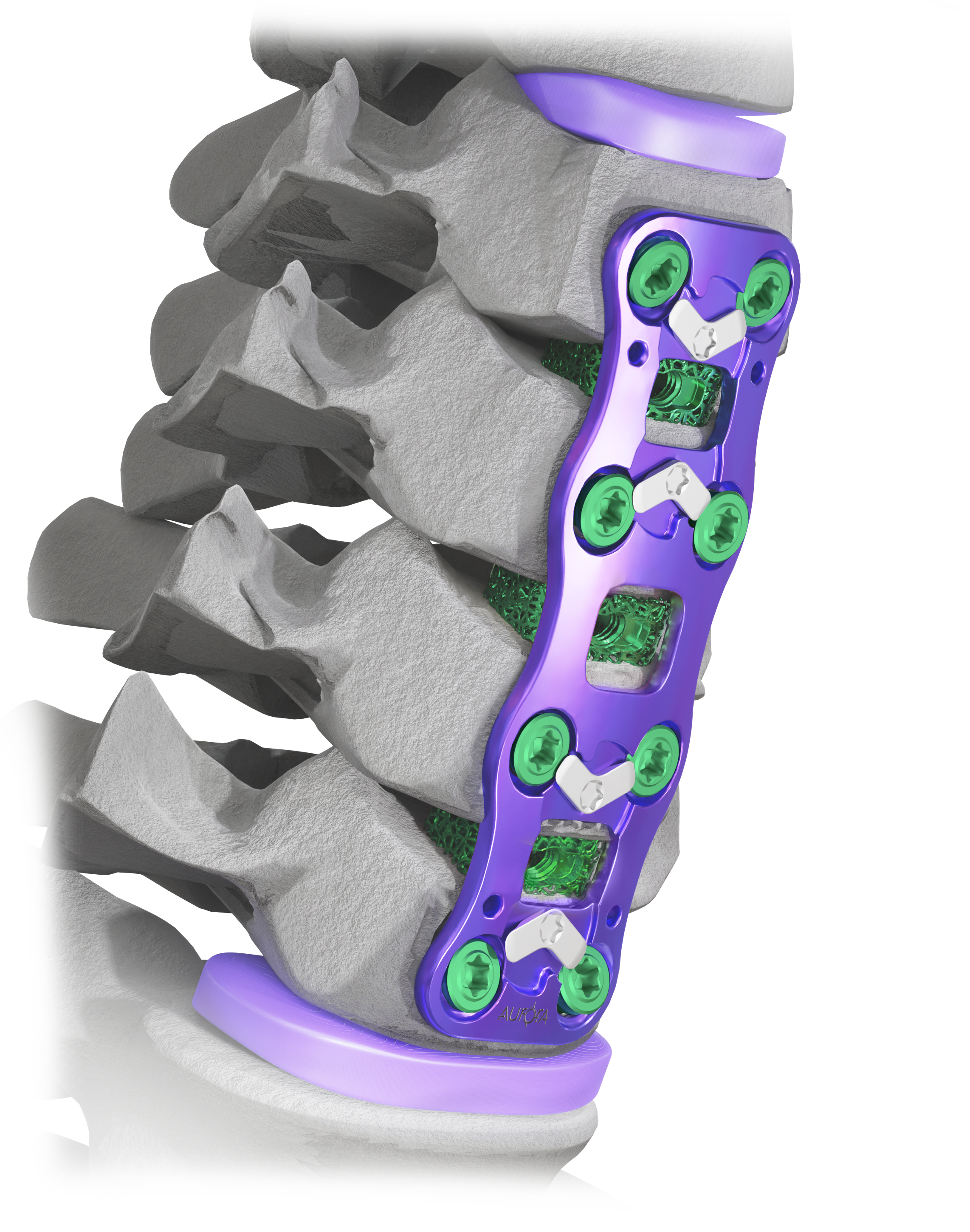 apollo™ Cervical System — Aurora - Simplifying The Complex - Spine
